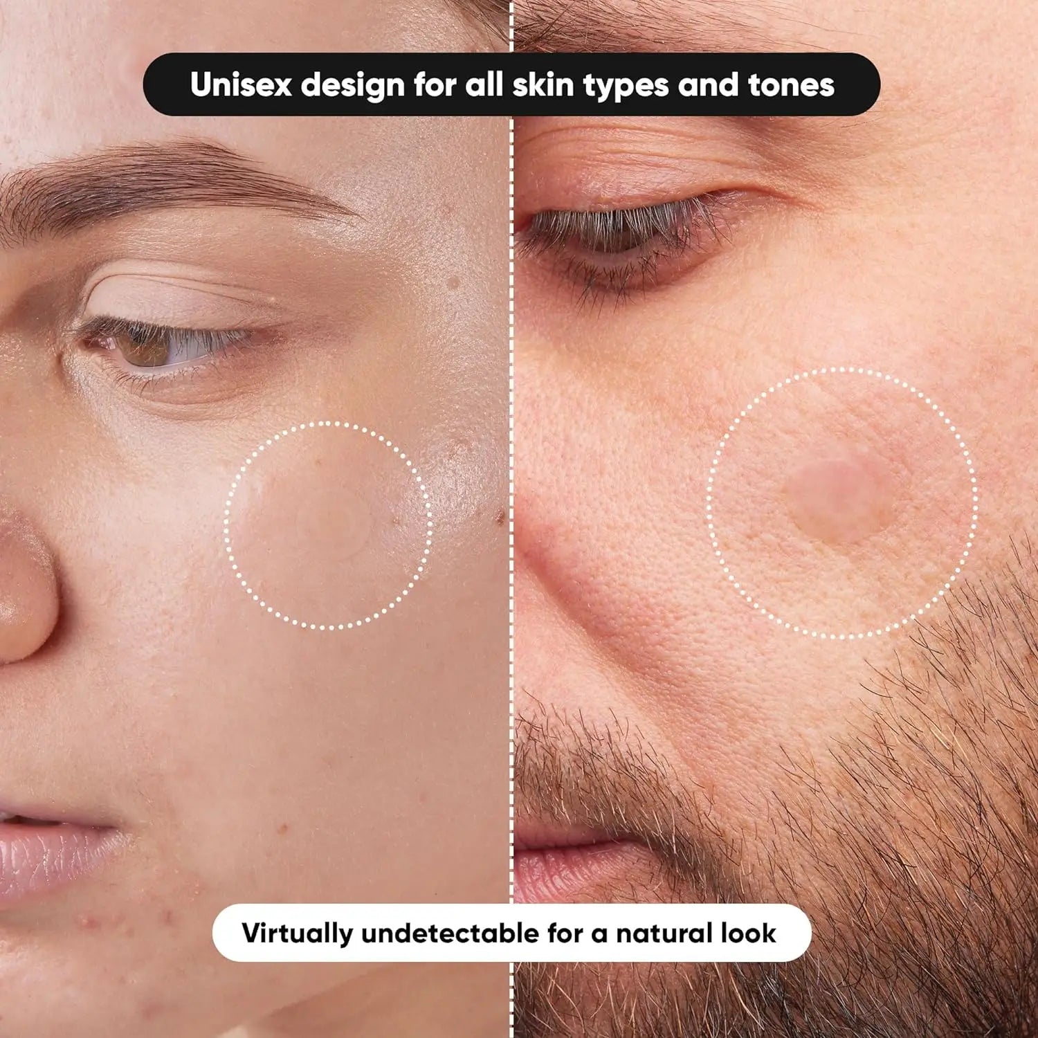 ClearSpot Hydrocolloid Acne Patches
